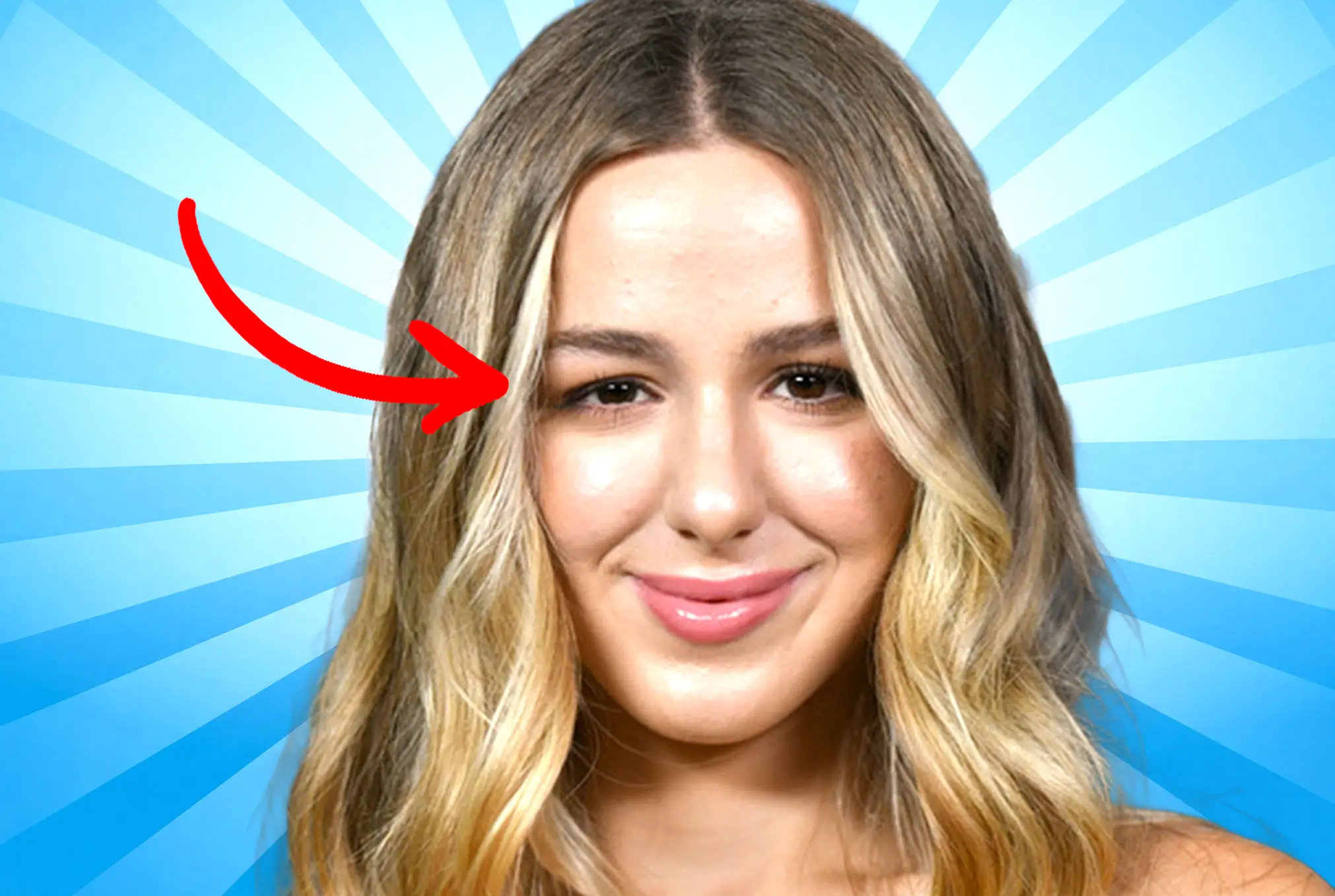 Chloe Lukasiak lazy eye